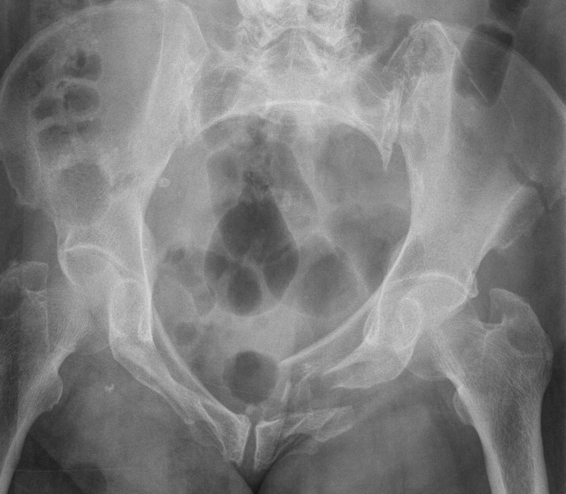 Pelvic Fracture LC2